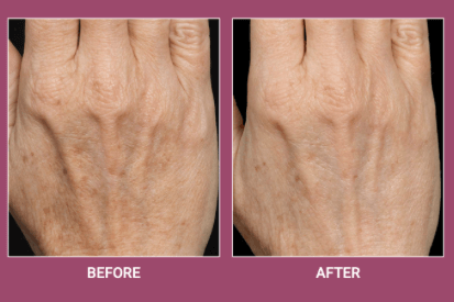 fraxel-laser-before-and-after-hand
