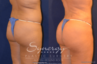 fat-grafting-on-butt-before-and-after
