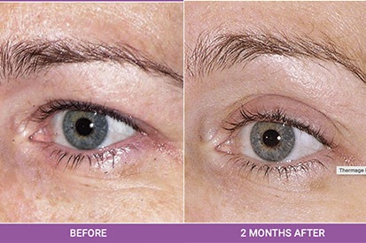 Thermage-before-and-after