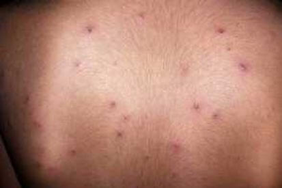 example-of-chicken-pox