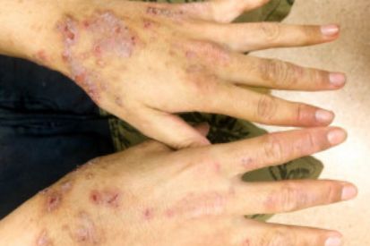 eczema-on-hands